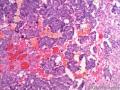 大网膜肿瘤：恶性间皮瘤？乳头状腺癌？图5