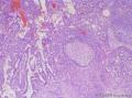 睾丸肿瘤：混合性生殖细胞肿瘤？图2