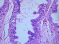 睾丸肿瘤：混合性生殖细胞肿瘤？图11