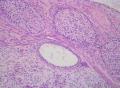睾丸肿瘤：混合性生殖细胞肿瘤？图14