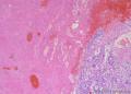 睾丸肿瘤：混合性生殖细胞肿瘤？图7