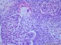 睾丸肿瘤：混合性生殖细胞肿瘤？图21
