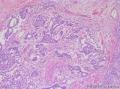睾丸肿瘤：混合性生殖细胞肿瘤？图5