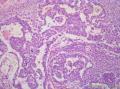 睾丸肿瘤：混合性生殖细胞肿瘤？图12