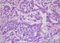 睾丸肿瘤：混合性生殖细胞肿瘤？图15