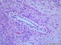 睾丸肿瘤：混合性生殖细胞肿瘤？图23