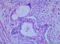 睾丸肿瘤：混合性生殖细胞肿瘤？图19