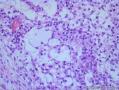 睾丸肿瘤：混合性生殖细胞肿瘤？图20