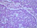 睾丸肿瘤：混合性生殖细胞肿瘤？图25