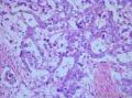 睾丸肿瘤：混合性生殖细胞肿瘤？图16