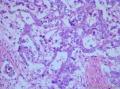 睾丸肿瘤：混合性生殖细胞肿瘤？图26
