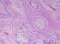 睾丸肿瘤：混合性生殖细胞肿瘤？图4