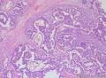 睾丸肿瘤：混合性生殖细胞肿瘤？图6