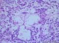 睾丸肿瘤：混合性生殖细胞肿瘤？图24