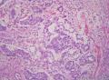 睾丸肿瘤：混合性生殖细胞肿瘤？图13