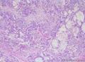 睾丸肿瘤：混合性生殖细胞肿瘤？图3
