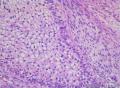 睾丸肿瘤：混合性生殖细胞肿瘤？图17