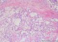 睾丸肿瘤：混合性生殖细胞肿瘤？图1