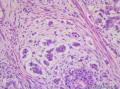 睾丸肿瘤：混合性生殖细胞肿瘤？图28