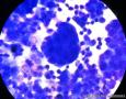 腹水，胃癌病史7年，是癌细胞还是间皮细胞？图10