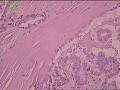 甲状腺组织，微小乳头状癌？图8