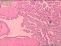 甲状腺组织，微小乳头状癌？图3
