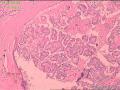 甲状腺组织，微小乳头状癌？图4