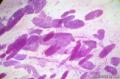 较为经典的乳腺穿刺细胞学图2