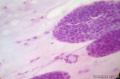 较为经典的乳腺穿刺细胞学图6