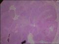 鳞状细胞癌图5