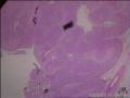 鳞状细胞癌图6