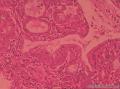 宫颈管赘生物图20