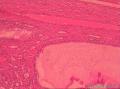宫颈管赘生物图6