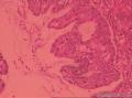宫颈管赘生物图25