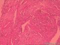 宫颈管赘生物图3