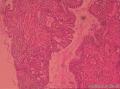 宫颈管赘生物图8