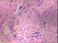 子宫肌瘤  核深染部分是什么？图8
