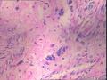 子宫肌瘤  核深染部分是什么？图10