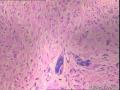 子宫肌瘤  核深染部分是什么？图1