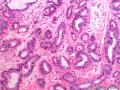 乳腺穿刺：考虑乳腺浸润性导管癌，1级？图5