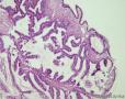 卵巢交界性粘液性囊腺瘤图15