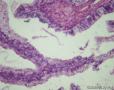 卵巢交界性粘液性囊腺瘤图13