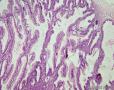 卵巢交界性粘液性囊腺瘤图1