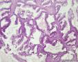 卵巢交界性粘液性囊腺瘤图10