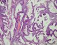 卵巢交界性粘液性囊腺瘤图6
