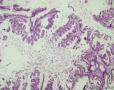 卵巢交界性粘液性囊腺瘤图7