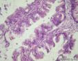 卵巢交界性粘液性囊腺瘤图8