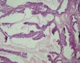 卵巢交界性粘液性囊腺瘤图14