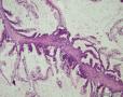 卵巢交界性粘液性囊腺瘤图5