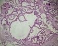 卵巢交界性粘液性囊腺瘤图2